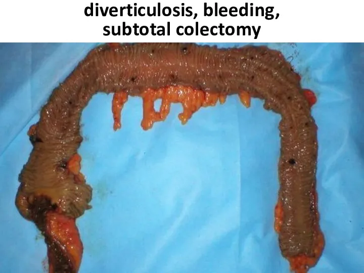 diverticulosis, bleeding, subtotal colectomy