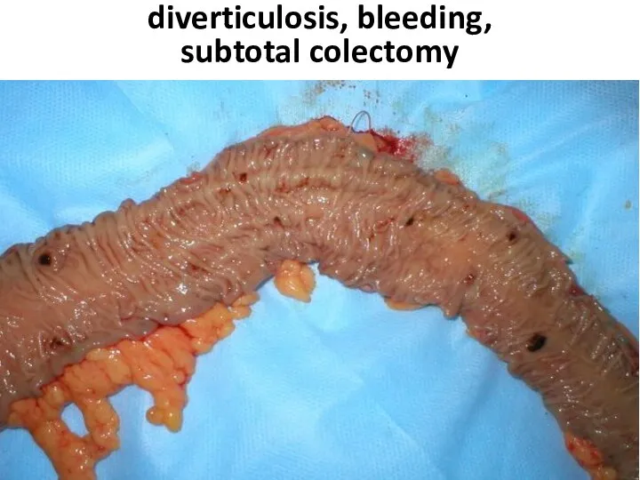 diverticulosis, bleeding, subtotal colectomy