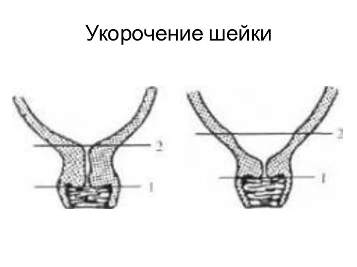 Укорочение шейки