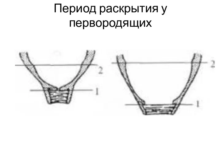 Период раскрытия у первородящих