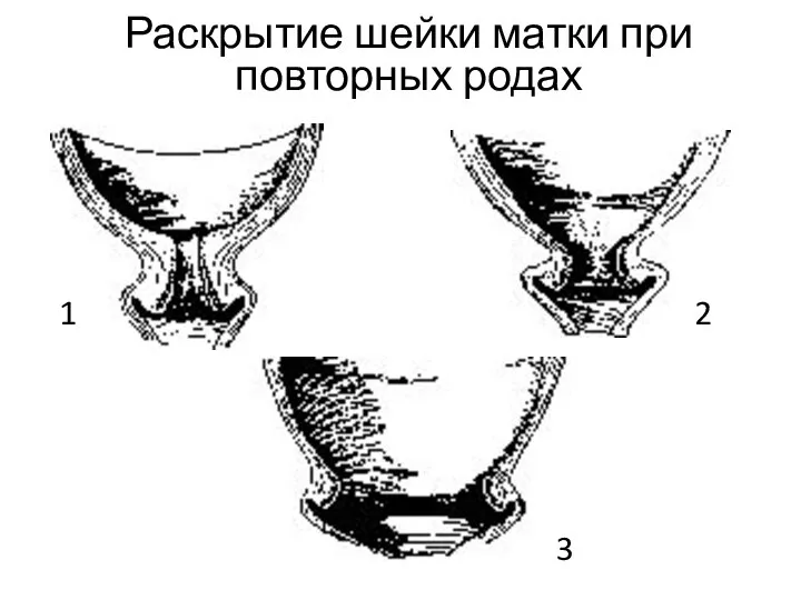 Раскрытие шейки матки при повторных родах 1 2 3