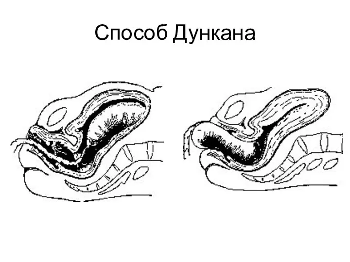 Способ Дункана