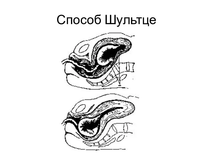 Способ Шультце