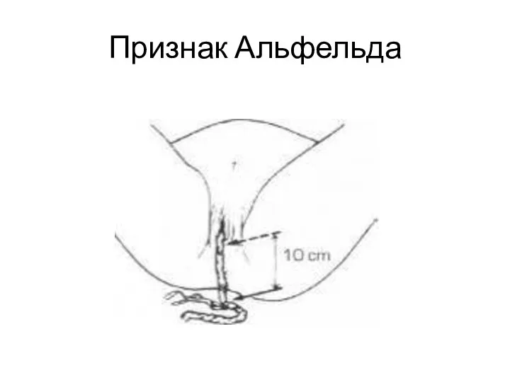 Признак Альфельда