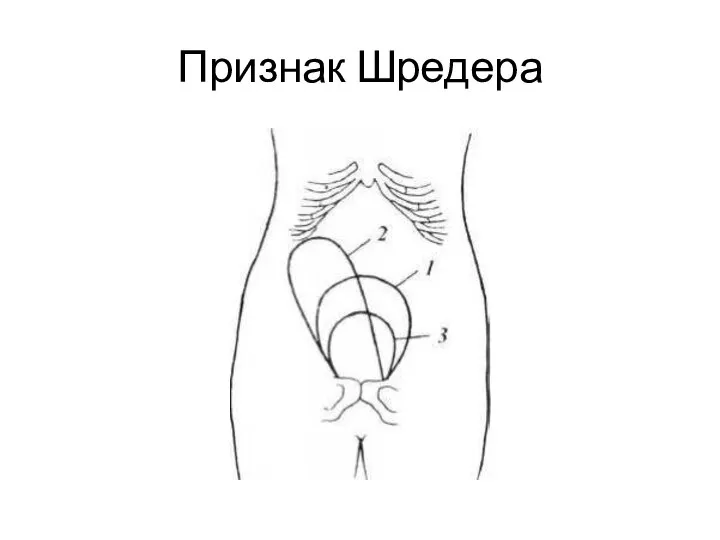 Признак Шредера