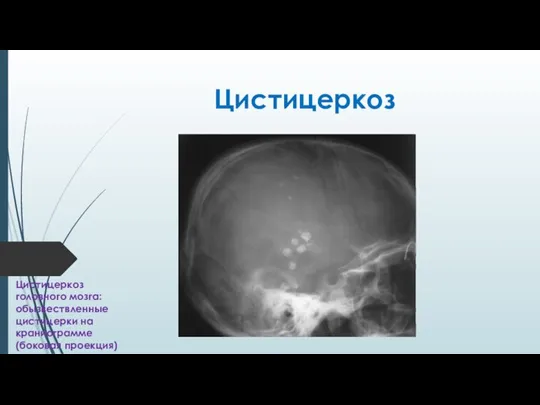 Цистицеркоз Цистицеркоз головного мозга: обызвествленные цистицерки на краниограмме (боковая проекция)