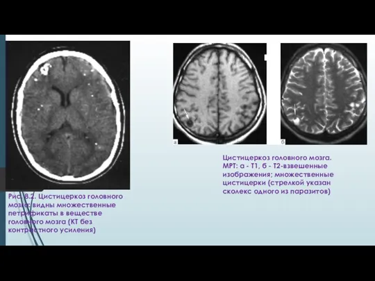 Рис. 8.2. Цистицеркоз головного мозга: видны множественные петрификаты в веществе головного мозга