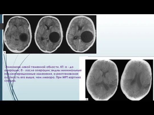 Эхинококк левой теменной области. КТ: а - до операции; б - после