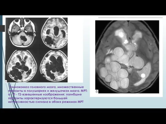 Эхинококкоз головного мозга, множественные паразиты в полушариях и желудочках мозга. МРТ: а