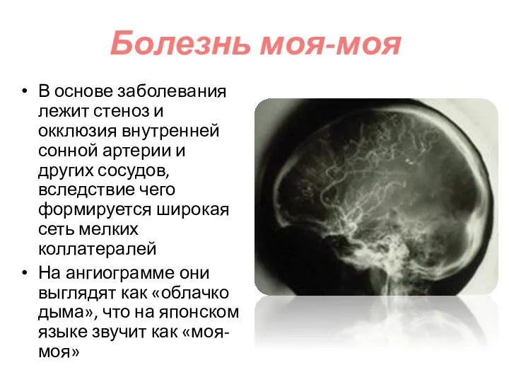 Болезнь моя-моя В основе заболевания лежит стеноз и окклюзия внутренней сонной артерии