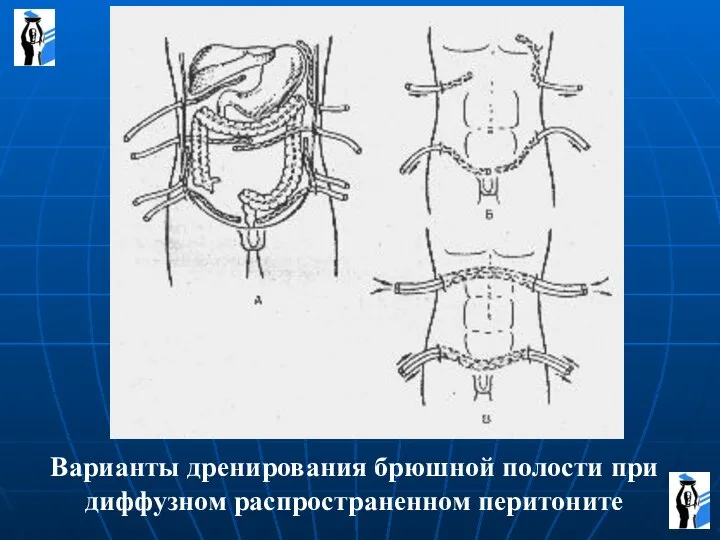 Варианты дренирования брюшной полости при диффузном распространенном перитоните