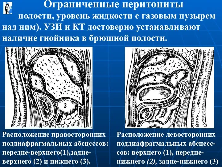 полости, уровень жидкости с газовым пузырем над ним). УЗИ и КТ достоверно