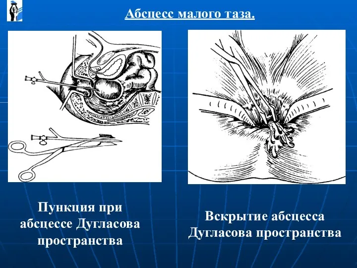 Абсцесс малого таза. Пункция при абсцессе Дугласова пространства Вскрытие абсцесса Дугласова пространства