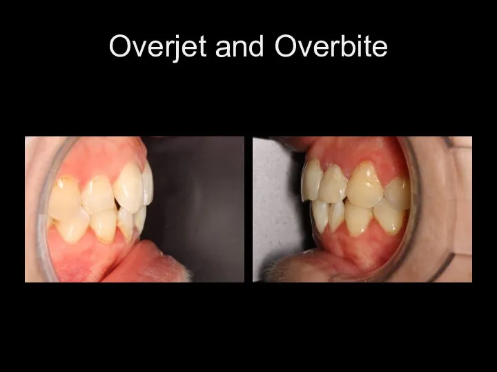 Overjet and Overbite