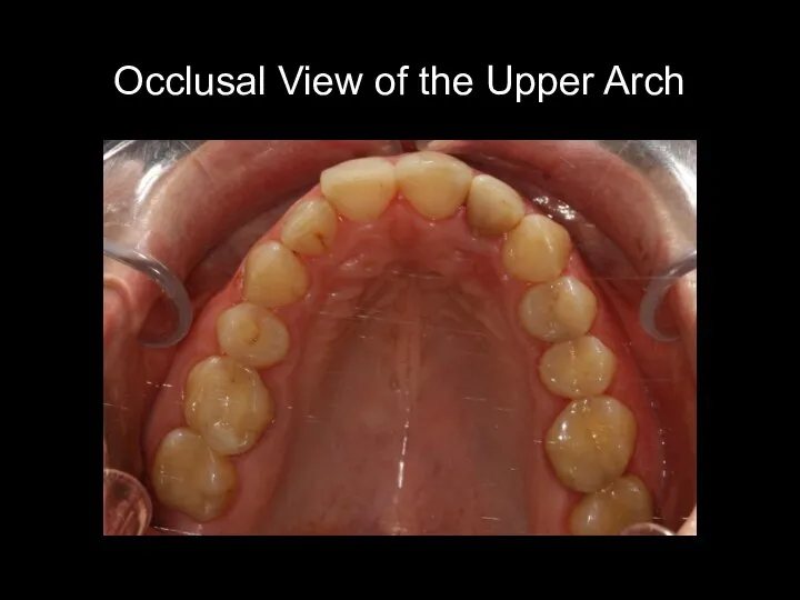 Occlusal View of the Upper Arch