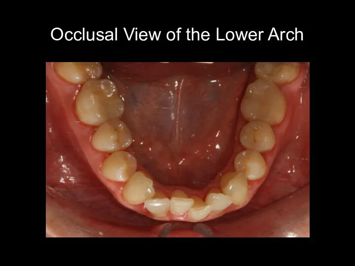 Occlusal View of the Lower Arch