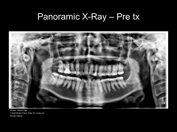 Panoramic X-Ray – Pre tx