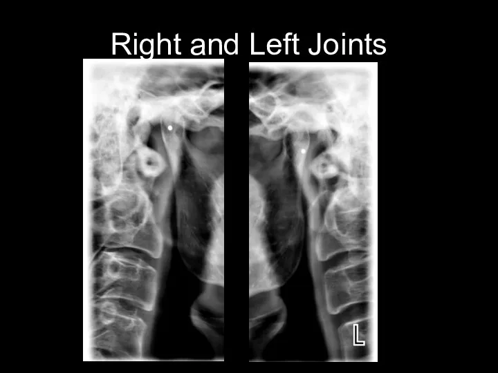 Right and Left Joints