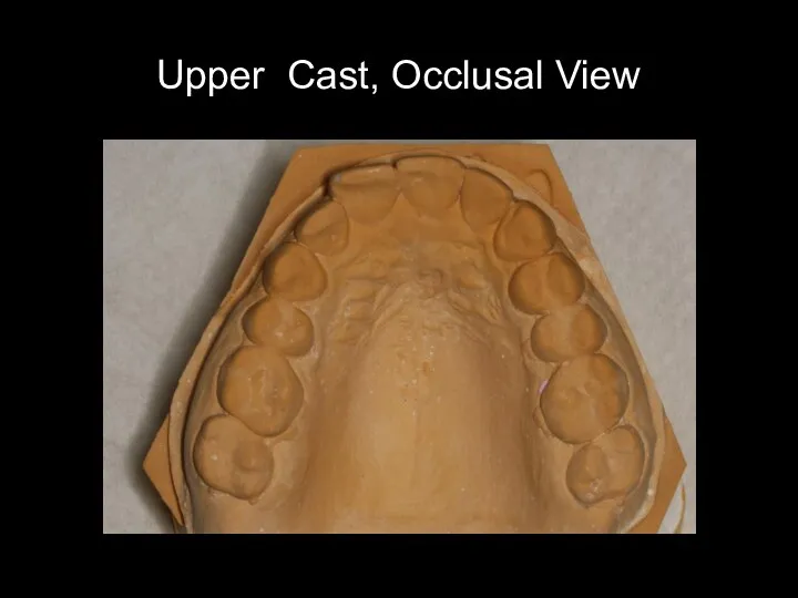 Upper Cast, Occlusal View