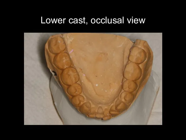 Lower cast, occlusal view