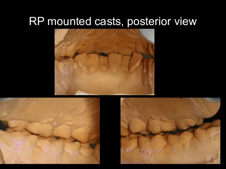 RP mounted casts, posterior view