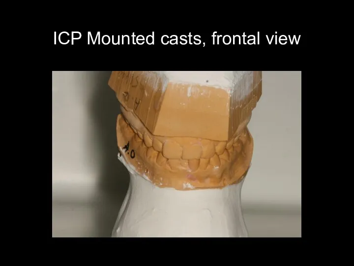 ICP Mounted casts, frontal view