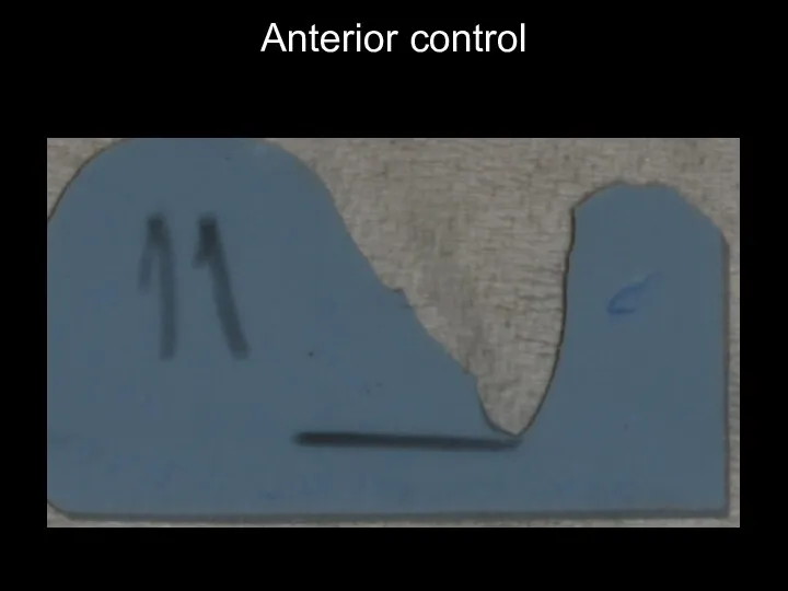 Anterior control