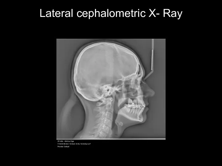 Lateral cephalometric X- Ray