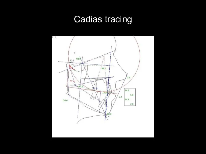 Cadias tracing