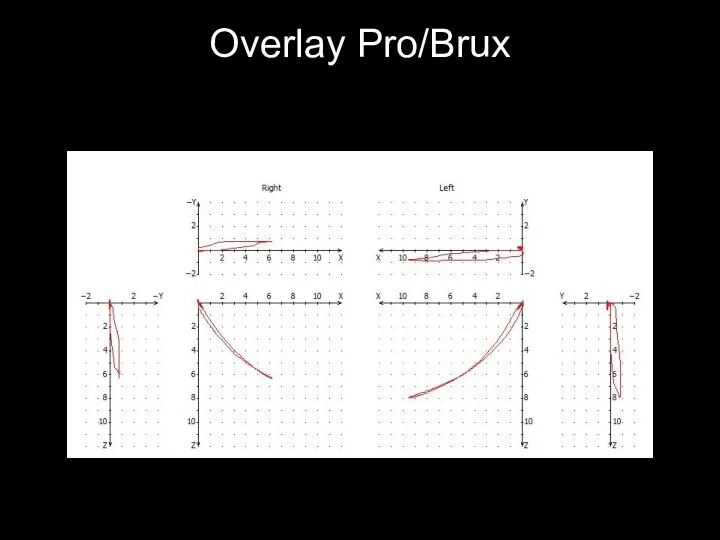 Overlay Pro/Brux