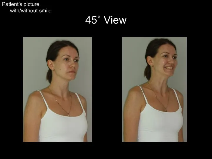 45˚ View Patient’s picture, with/without smile