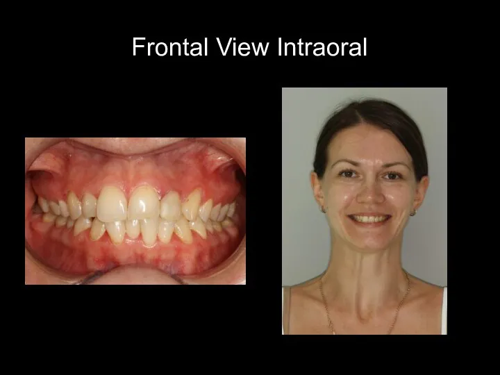 Frontal View Intraoral