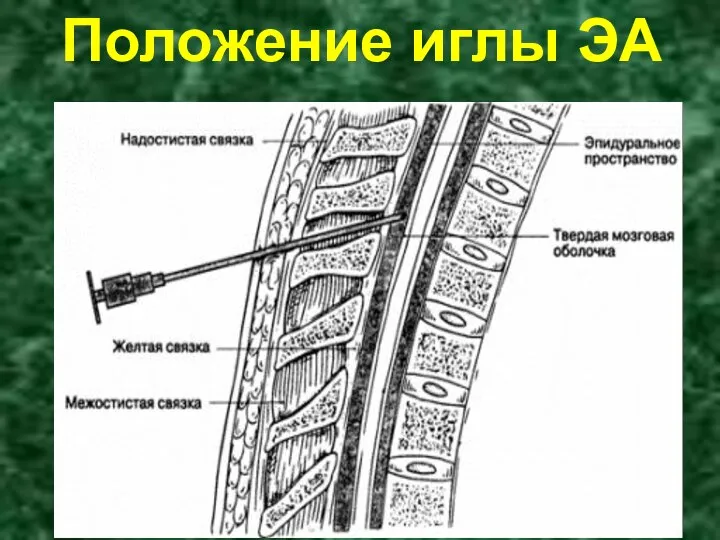 Положение иглы ЭА