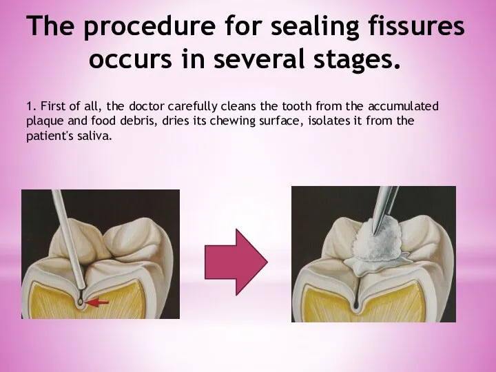 The procedure for sealing fissures occurs in several stages. 1. First of