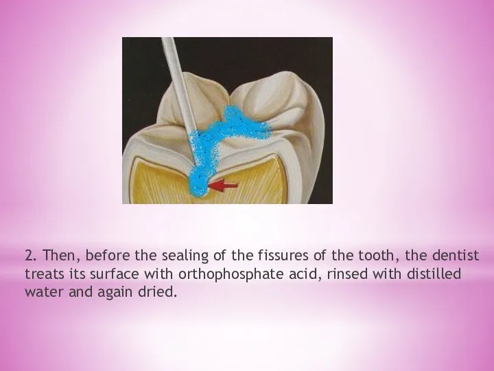 2. Then, before the sealing of the fissures of the tooth, the