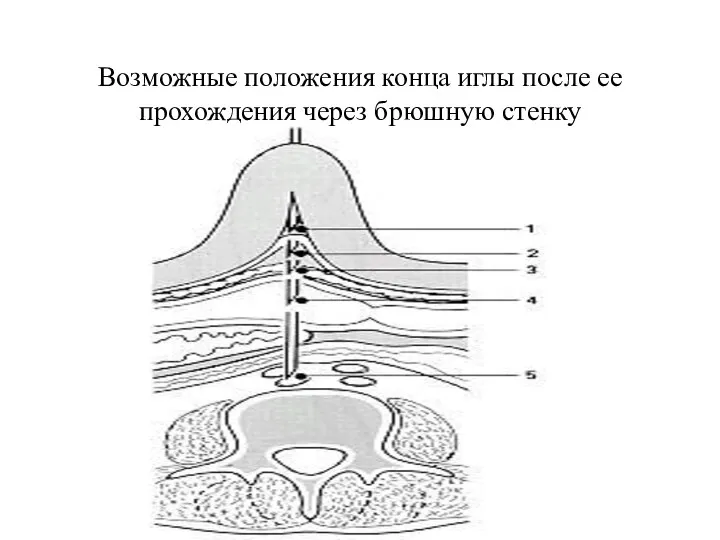 Возможные положения конца иглы после ее прохождения через брюшную стенку