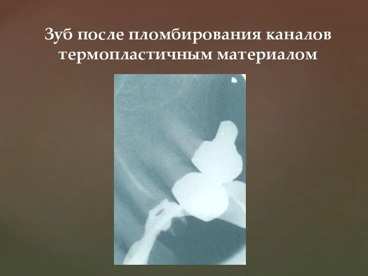 Зуб после пломбирования каналов термопластичным материалом