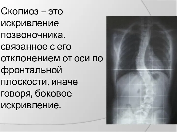 Сколиоз – это искривление позвоночника, связанное с его отклонением от оси по