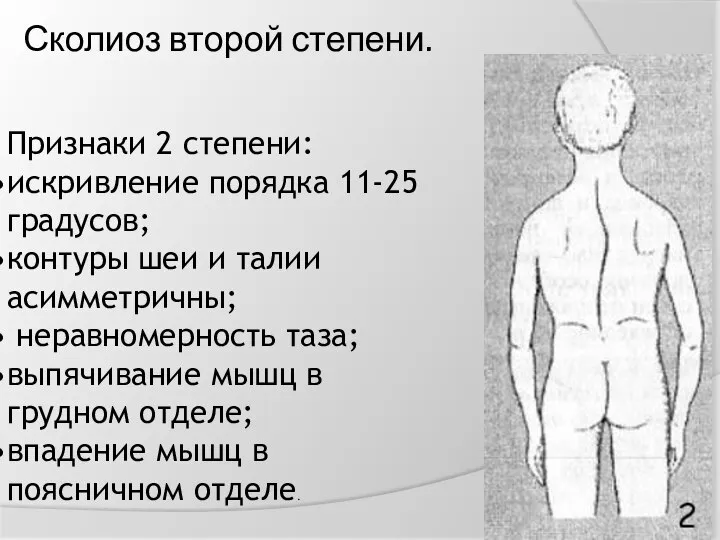 Сколиоз второй степени. Признаки 2 степени: искривление порядка 11-25 градусов; контуры шеи