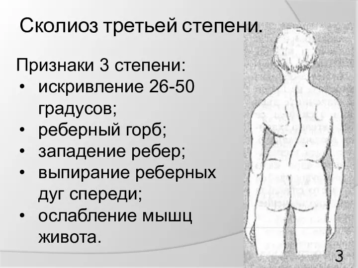 Сколиоз третьей степени. Признаки 3 степени: искривление 26-50 градусов; реберный горб; западение