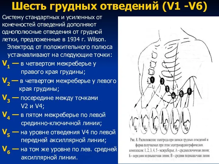 Шесть грудных отведений (V1 -V6) Систему стандартных и усиленных от конечностей отведений