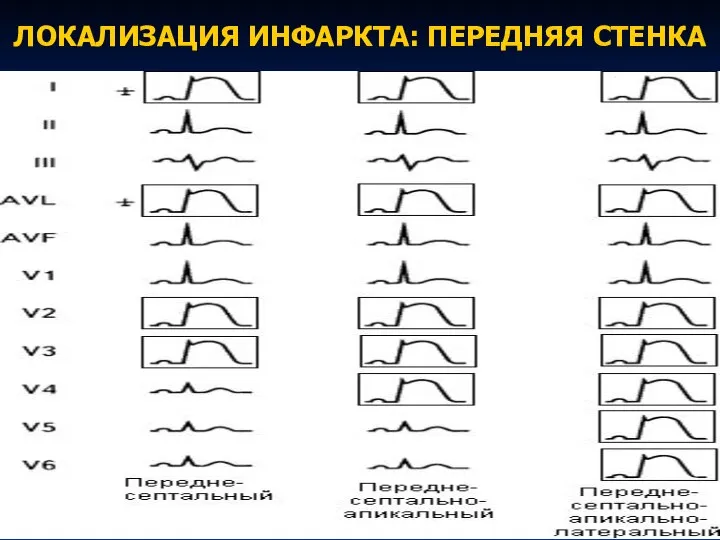 ЛОКАЛИЗАЦИЯ ИНФАРКТА: ПЕРЕДНЯЯ СТЕНКА