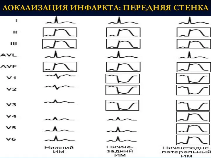 ЛОКАЛИЗАЦИЯ ИНФАРКТА: ПЕРЕДНЯЯ СТЕНКА