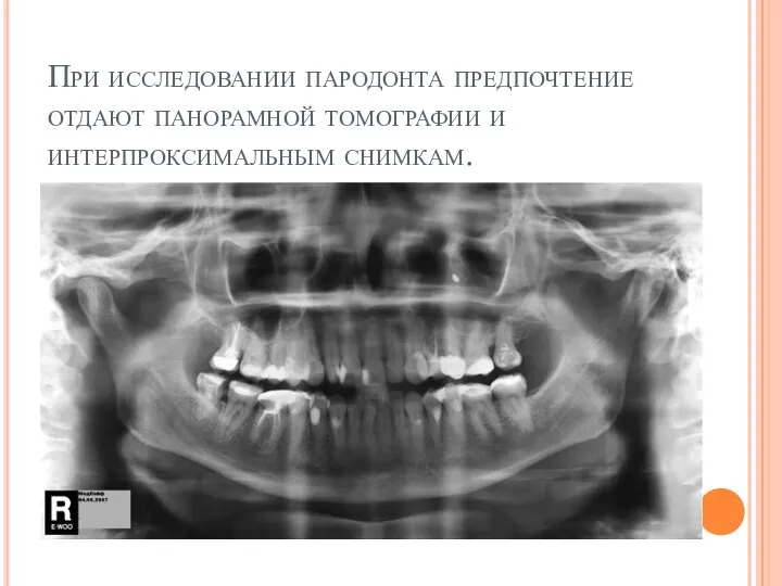 При исследовании пародонта предпочтение отдают панорамной томографии и интерпроксимальным снимкам.