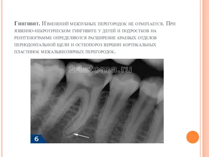 Гингивит. Изменений межзубных перегородок не отмечается. При язвенно-некротическом гингивите у детей и