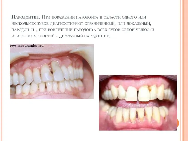 Пародонтит. При поражении пародонта в области одного или нескольких зубов диагностируют ограниченный,