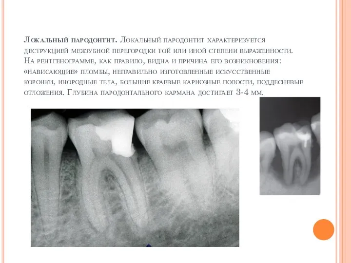 Локальный пародонтит. Локальный пародонтит характеризуется деструкцией межзубной перегородки той или иной степени
