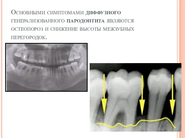 Основными симптомами диффузного генерализованного пародонтита являются остеопороз и снижение высоты межзубных перегородок.