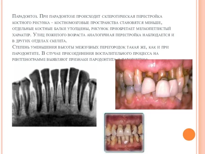 Парадонтоз. При парадонтозе происходит склеротическая перестройка костного рисунка - костномозговые пространства становятся