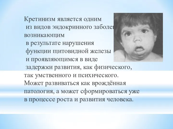 Кретинизм является одним из видов эндокринного заболевания,возникающим в результате нарушения функции щитовидной